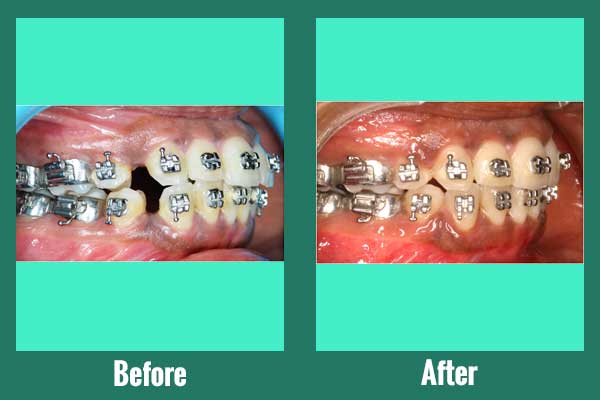 Braces Used With Tooth Extractions