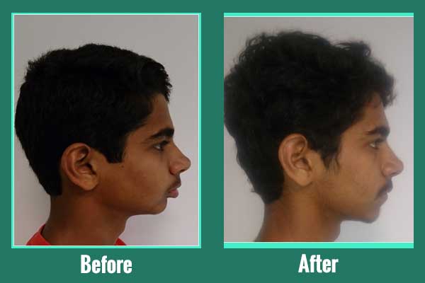 Lower Jaw growth with Myo-functional appliance