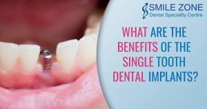 What are the benefits of the Single Tooth Dental Implants?