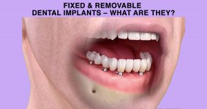 Fixed & Removable Dental Implants – what are they?
