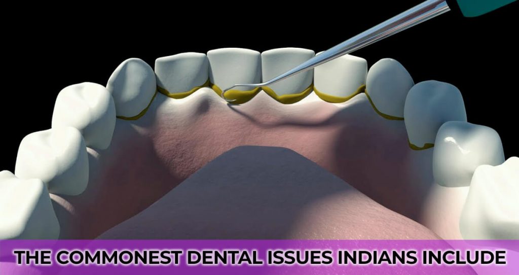 The commonest dental issues Indians include;