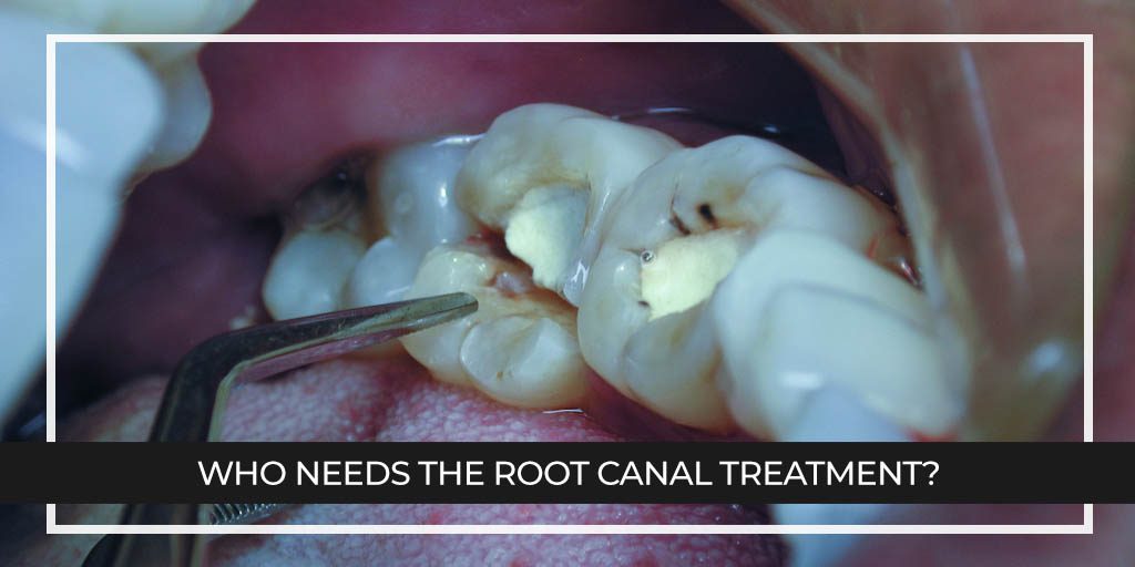 Who needs the Root Canal Treatment?