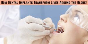 How Dental Implants Transform Lives Around the Globe!