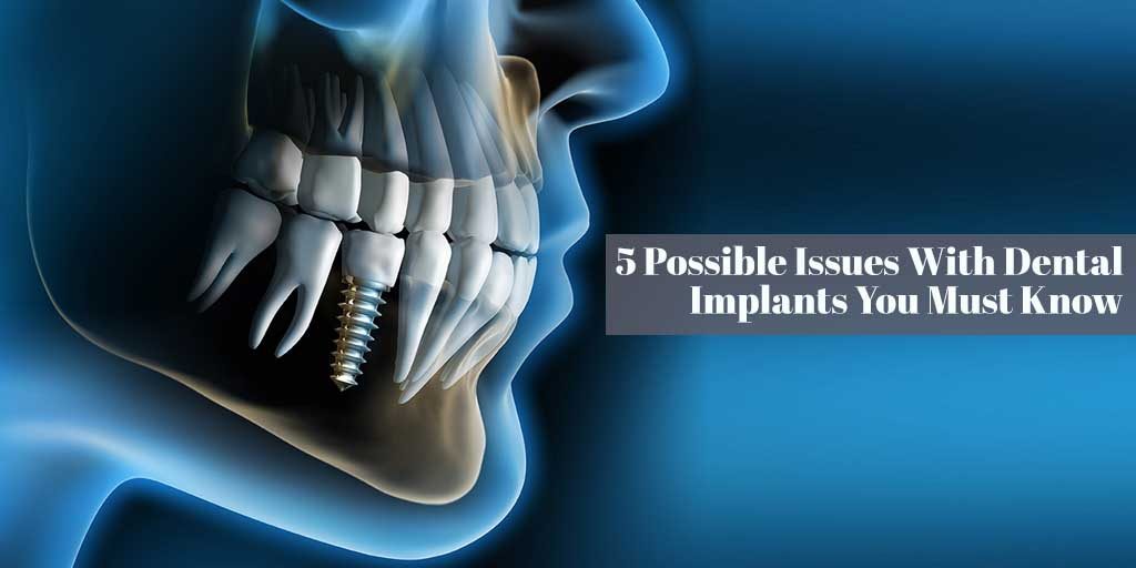 5 Possible Issues With Dental Implants You Must Know