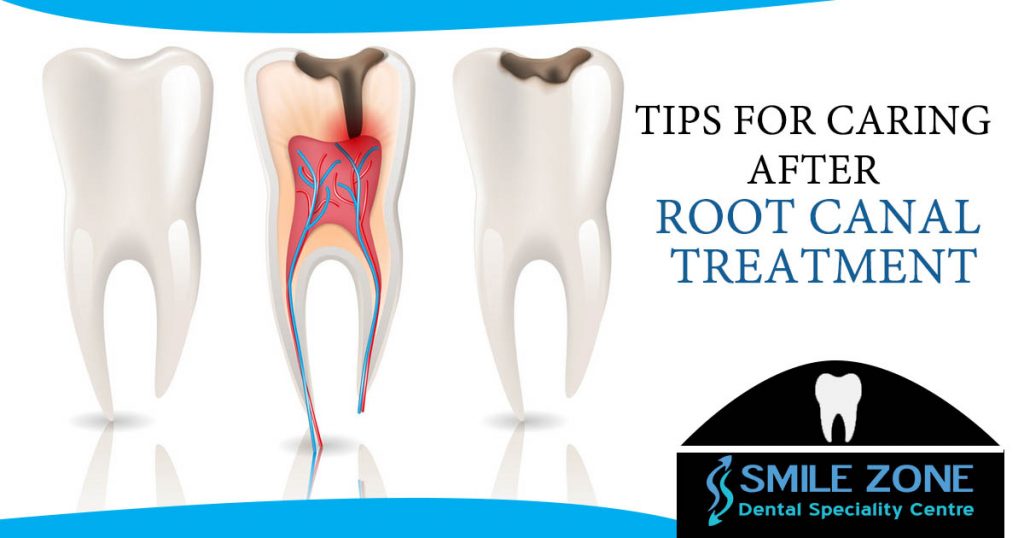 Tips for caring after root canal treatment