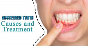 Abscessed Tooth - Causes and treatment