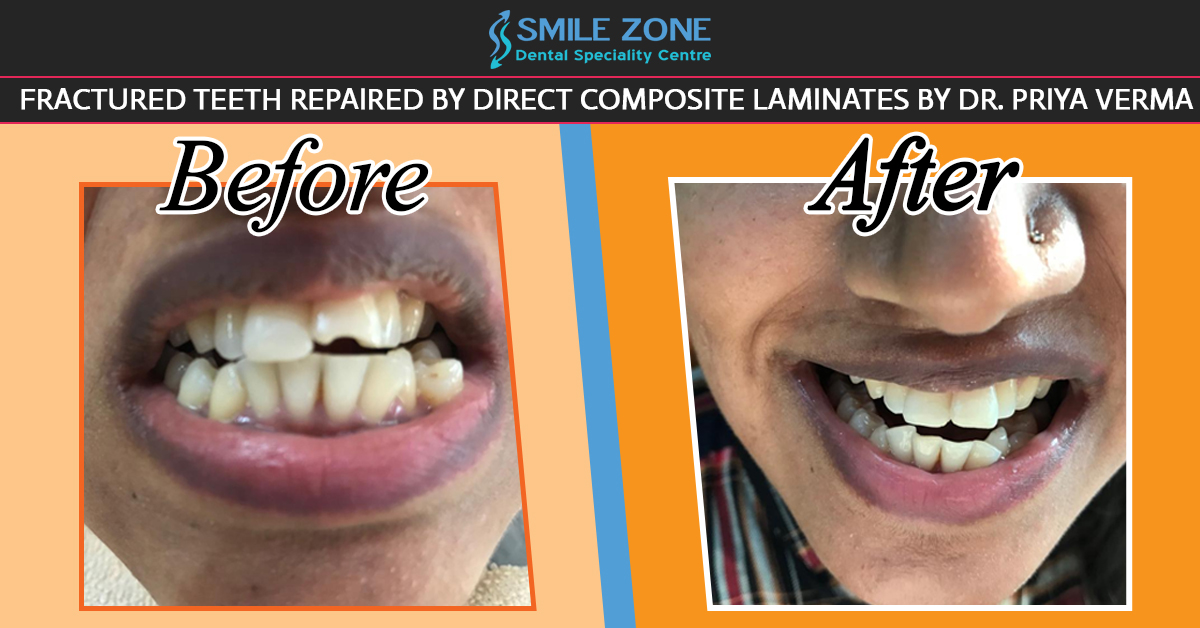 Before And After Broken Teeth Repair