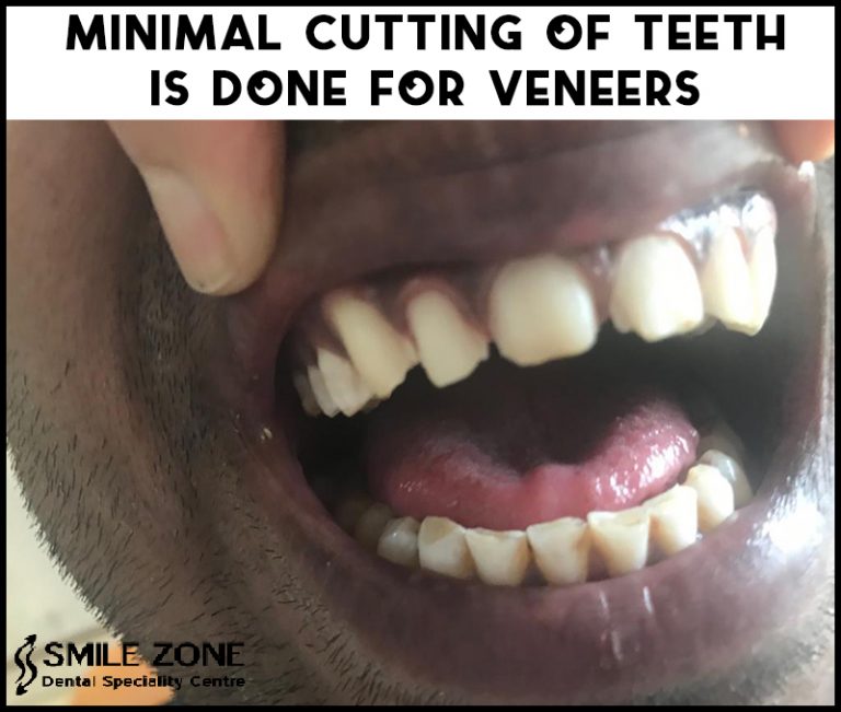 Beautify Your Teeth with Veneers From Smile Zone In Bangalore