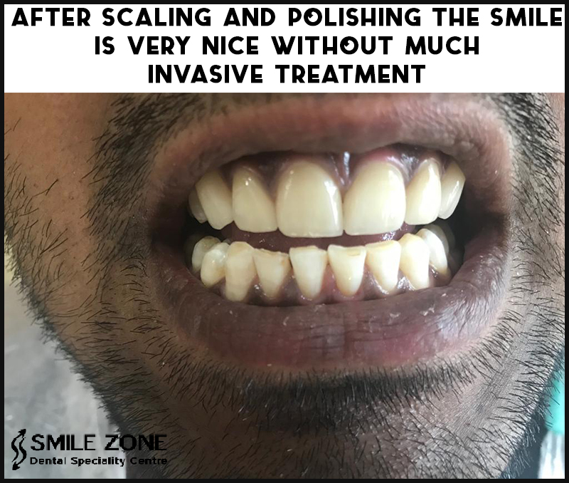 After Scaling and Polishing the Smile is Very Nice Without Much Invasive Treatment