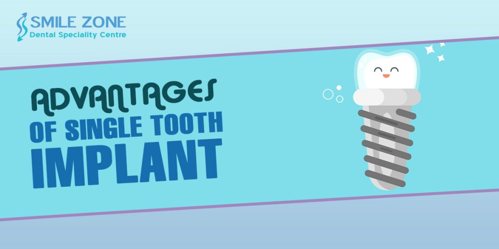 Advantages of Single Tooth Implant