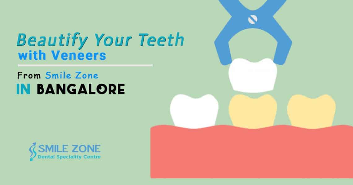 Beautify Your Teeth with Veneers From Smile Zone In Bangalore