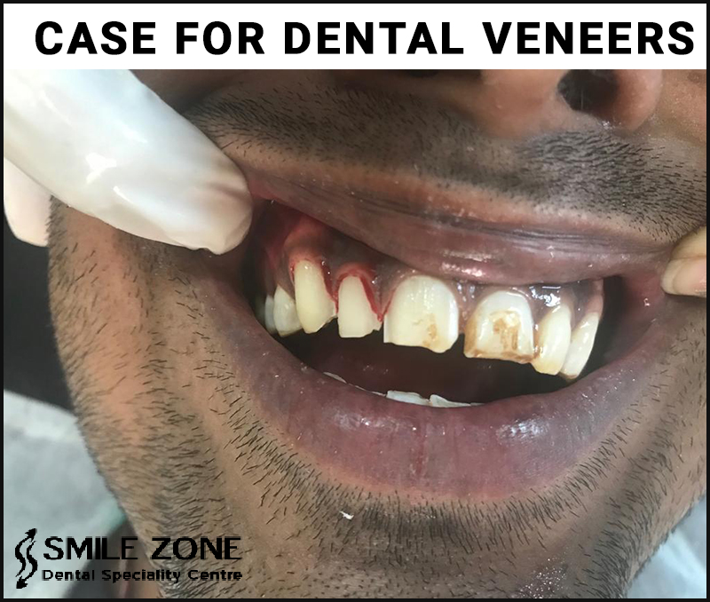 Case for Dental Veneers