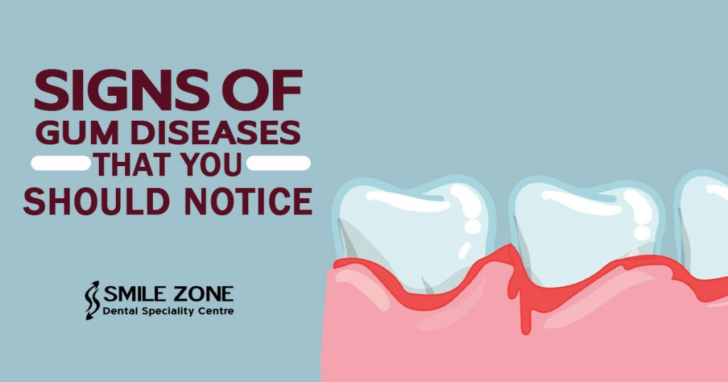 Signs of Gum Diseases that You Should Notice