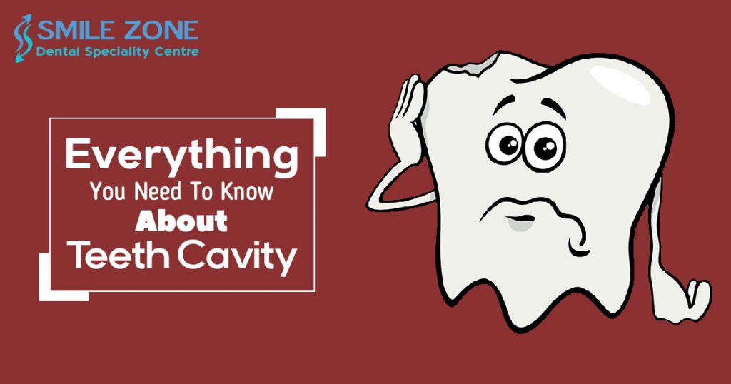 Everything You Need To Know About Teeth Cavity