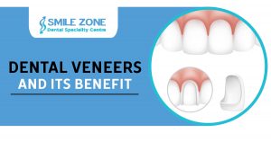 Dental Veneers and its benefit copy