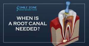 When Is A Root Canal Needed