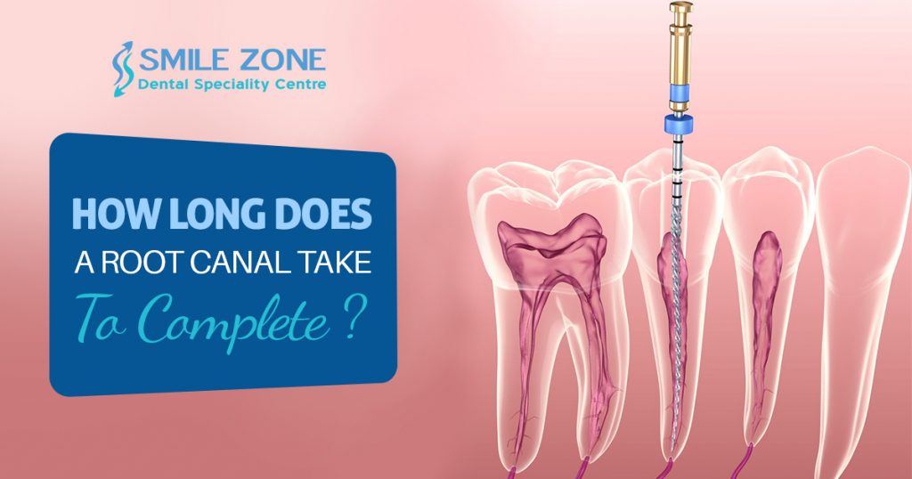 How Long Does A Root Canal Take To Complete