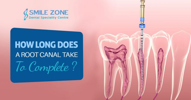 How long does Root Canal Take To Complete?