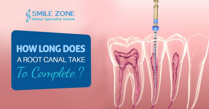 How long does Root Canal Take To Complete?