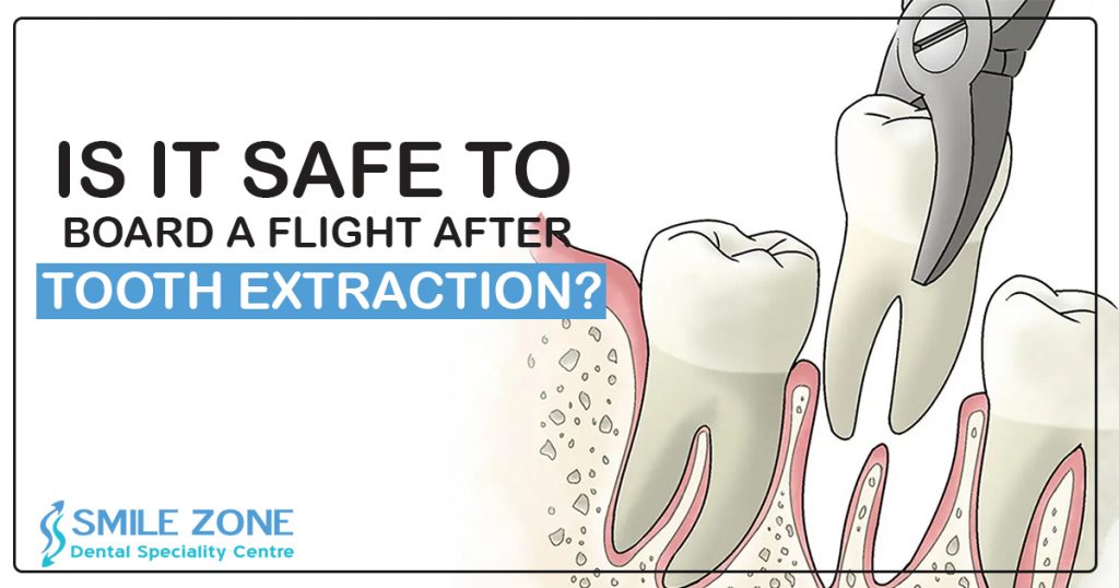 Is it safe to board a flight after tooth extraction