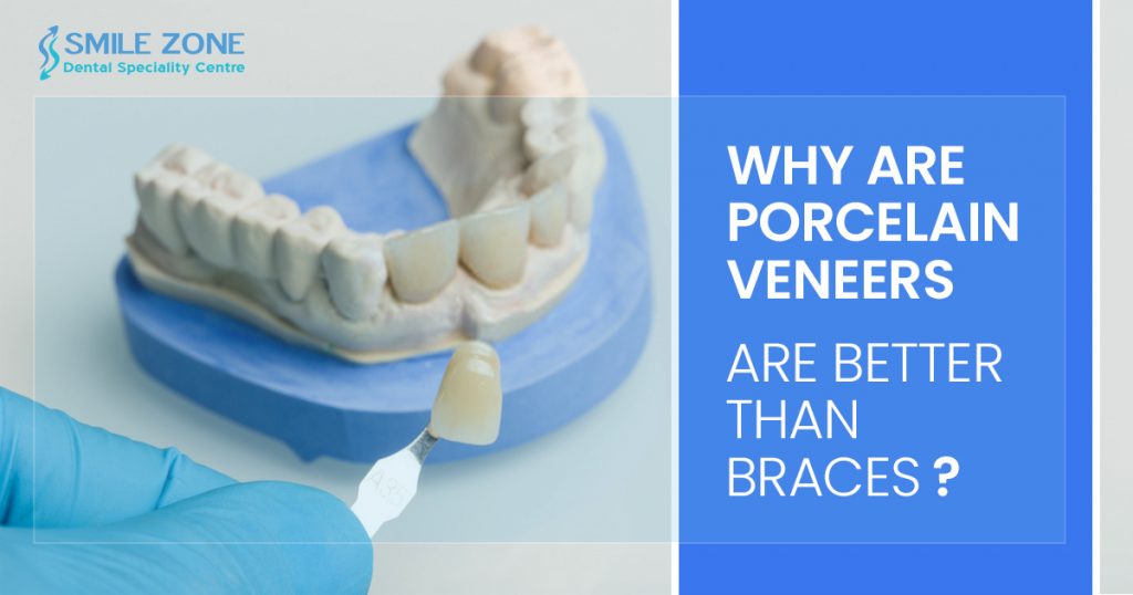 Why Are porcelain veneers are better than braces