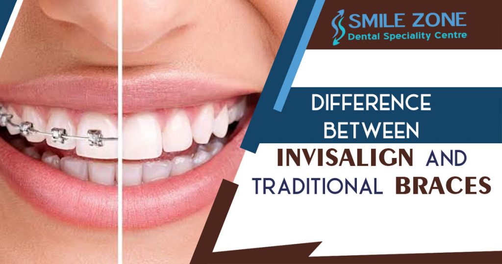 difference between Invisalign and traditional braces