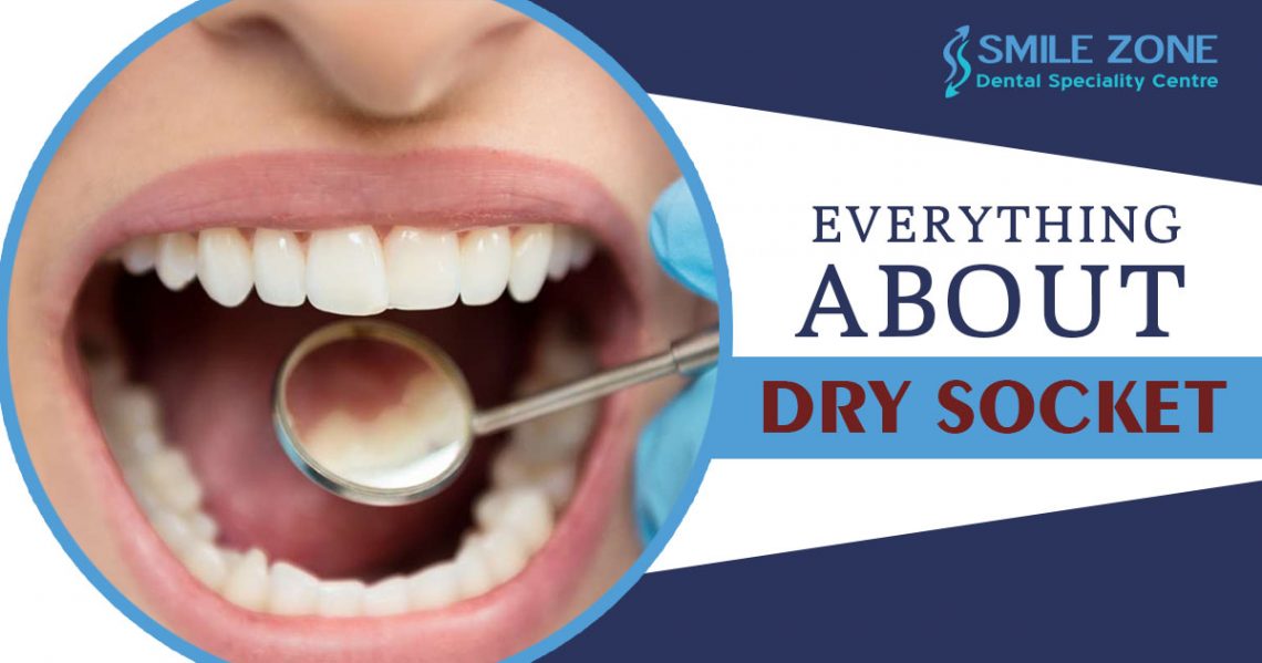 Everything You must know about Dry Socket