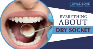 Everything about Dry Socket