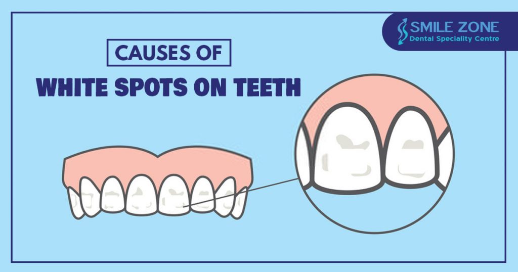 Causes of white spots on teeth