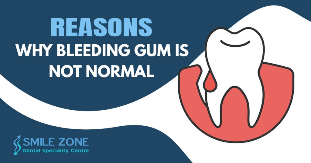 Reasons Why bleeding gum is not normal