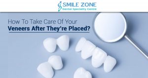 How to take care of your veneers after they’re placed