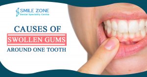 Causes of swollen gums around one tooth