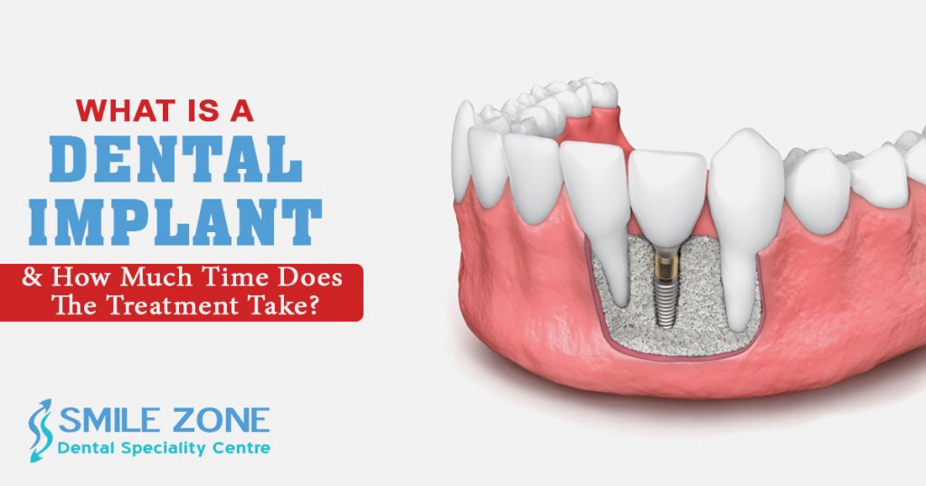 What is a dental implant and how much time does the treatment take