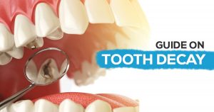 Guide on tooth Decay