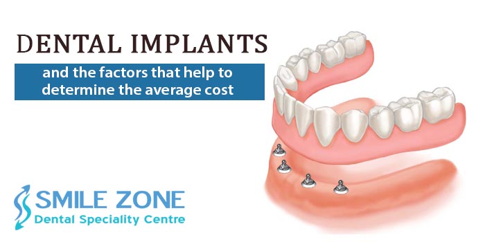 Dental Implants and the factors that help to determine the average cost