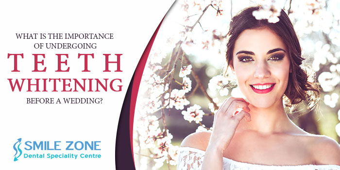 What is the importance of undergoing teeth whitening before a wedding?