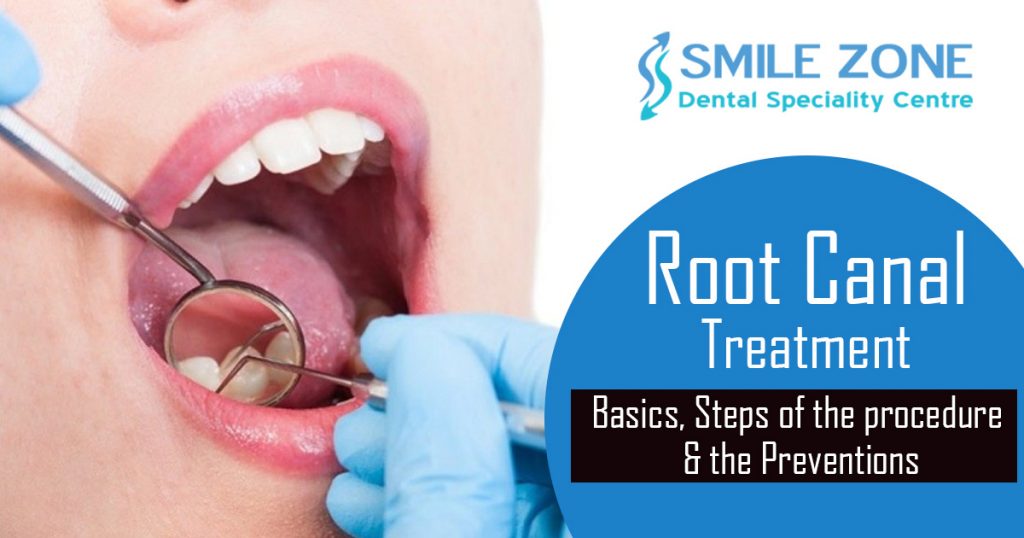 Root canal treatment - Basics, Steps of the procedure & the Preventions