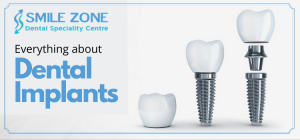 Everything about dental implants