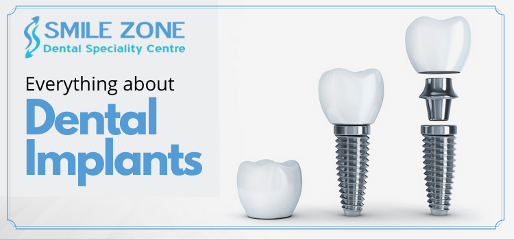 Everything about dental implants