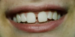 teeth gap