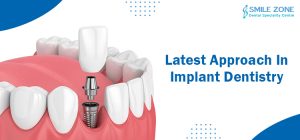 Latest Approach In Implant Dentistry