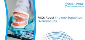 FAQs About Implant-Supported Overdentures