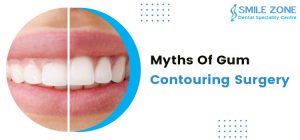 Myths Of Gum Contouring Surgery