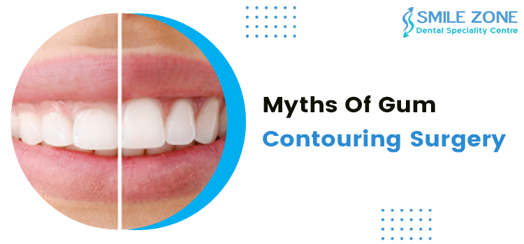 Myths Of Gum Contouring Surgery
