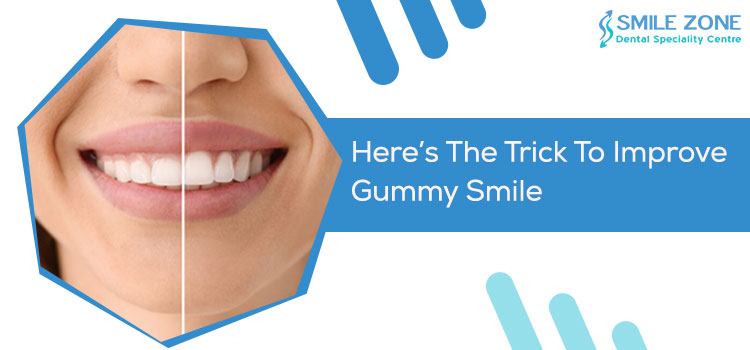 Here’s-The-Trick-To-Improve-Gummy-Smile