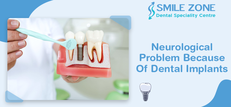 Neurological Problem Because Of Dental Implants