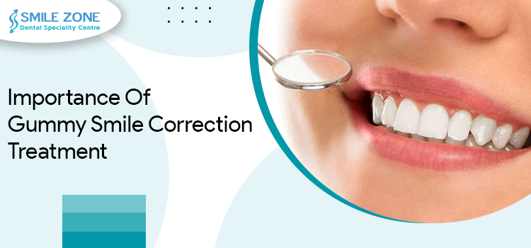 Importance Of Gummy Smile Correction Treatment