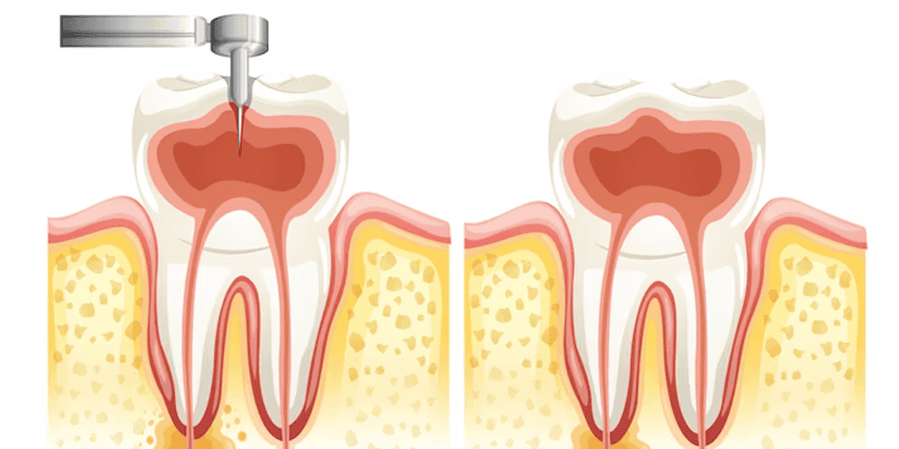 Dental Post & Core Wakad